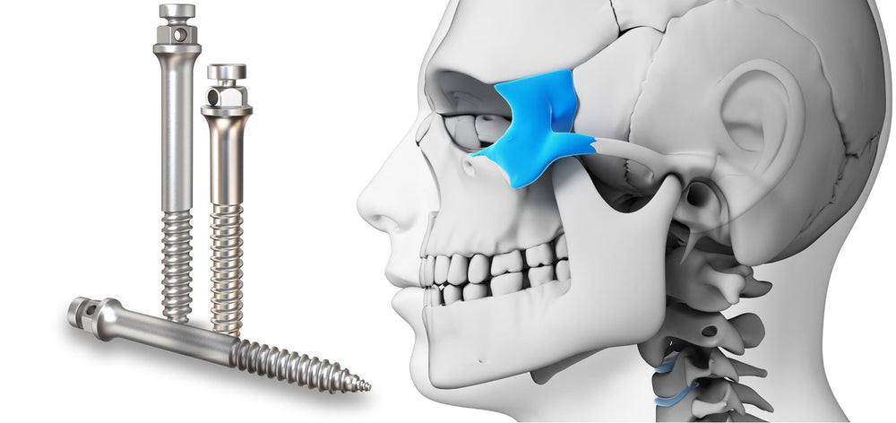 Zygomatic TAD Orthodontic Mini-screw – WholeDent