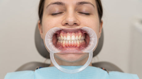  How to Use Dental Cheek Retractor 
