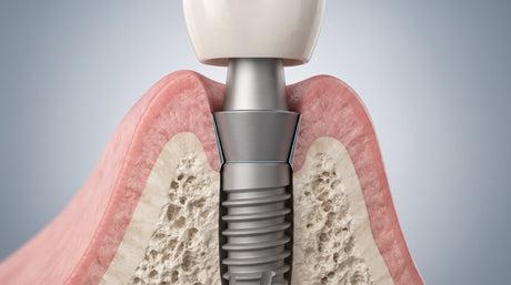  What Are Screwless Dental Implants 