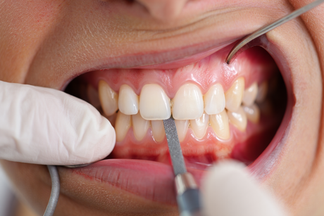  Interproximal Stripping 