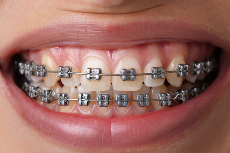  Orthodontic Bracket Types 