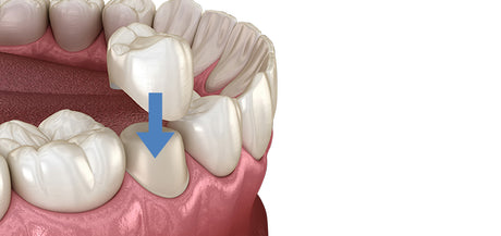  Dental Crowns 
