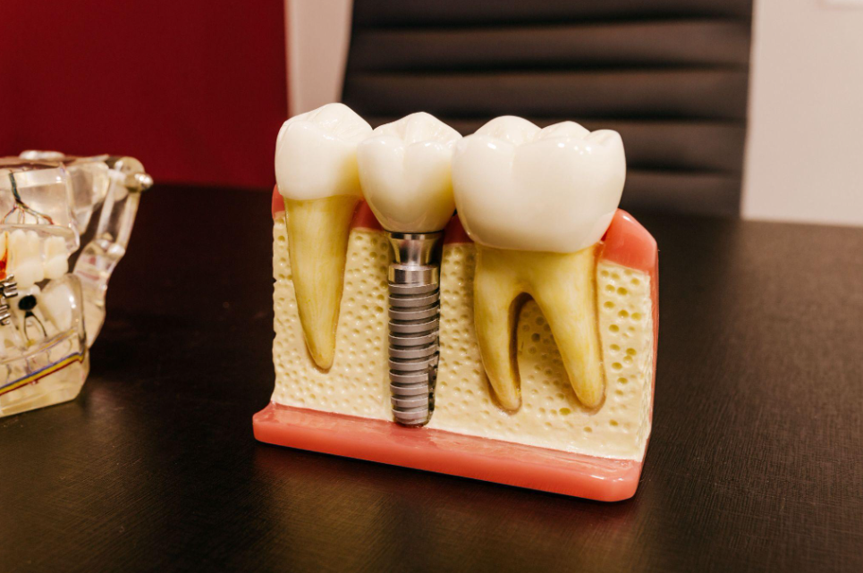  how to check primary stability of implant 