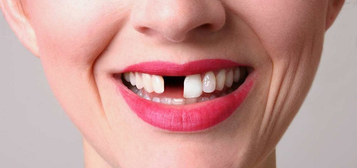 Tooth Replacement - Know Your Options