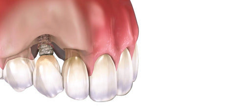  Peri-implantitis - Everything you Need To Know 