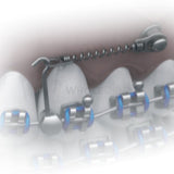 Morelli NiTi Closed Coil Spring For Mini Screw w/eyelets 7mm-Orthodontic Wire-WholeDent.com