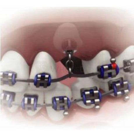  Morelli Non-Errupted Teeth Hook Traction Chain Buttons-Chain Buttons-WholeDent.com 